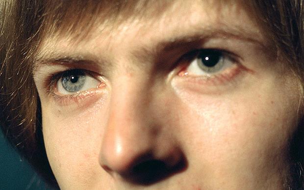 Culture Trivia Question: Why did David Bowie have two different eyes?