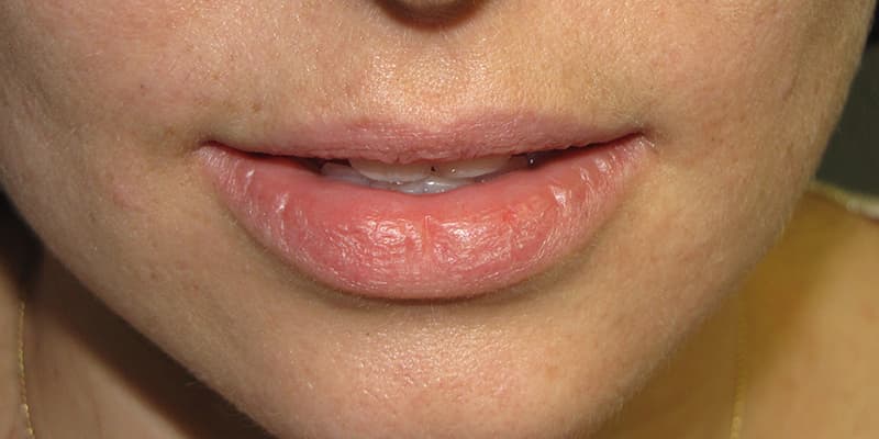 Science Trivia Question: What is another name(s) for Actinic Cheilitis?