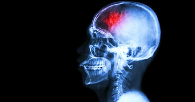 Science Trivia Question: What does CTE stand for in Medicine?