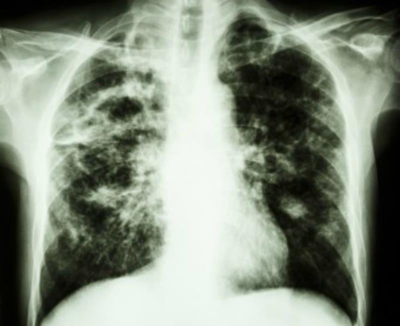 Science Trivia Question: Who coined the term “tuberculosis'?