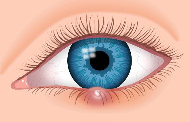 nauka Pytanie-Ciekawostka: Jaki jest termin medyczny na jęczmień na oku?