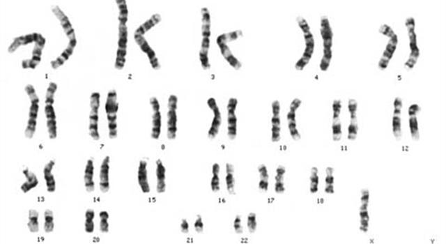 Science Trivia Question: What  syndrome is associated with partial or complete missing of one of the X chromosomes?