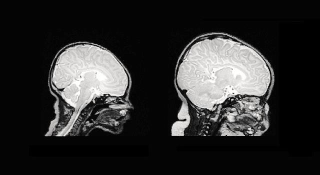 Science Trivia Question: How much energy does a developing brain in an infant consume?