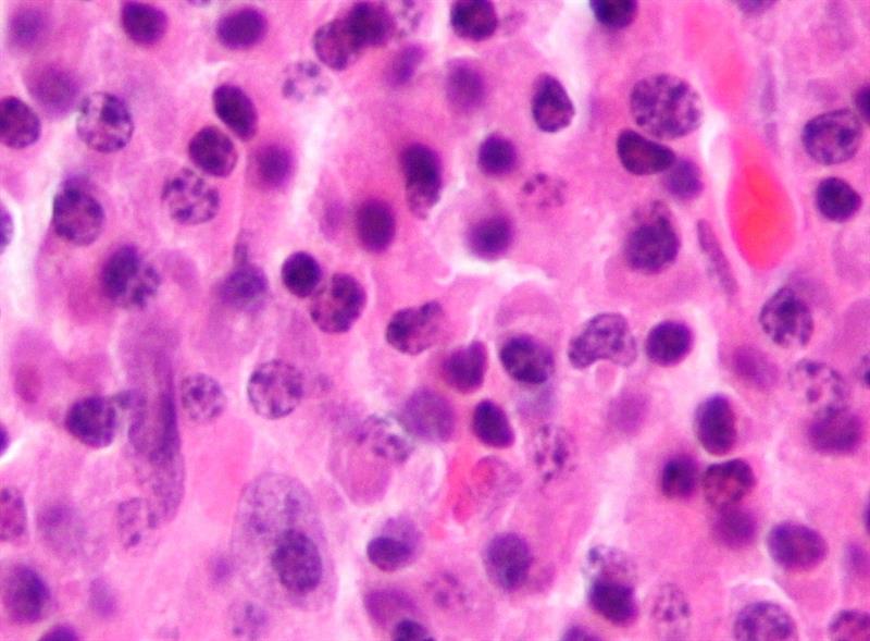 Science Trivia Question: What is multiple myeloma?