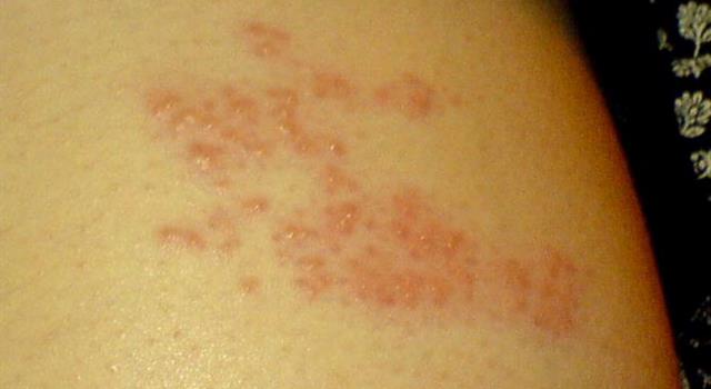 Science Trivia Question: What is shingles?