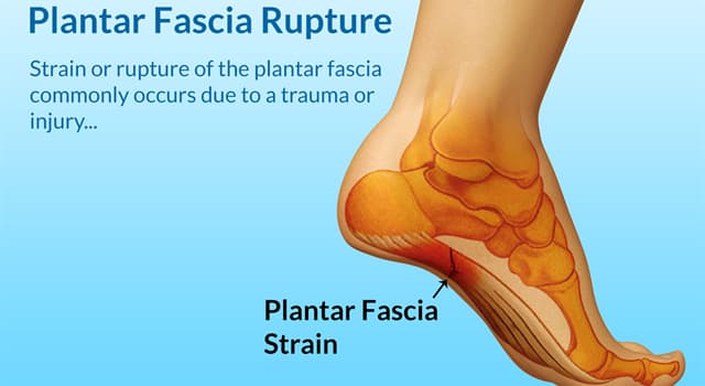 Science Trivia Question: The painful foot condition plantar fasciitis is also known by what name?
