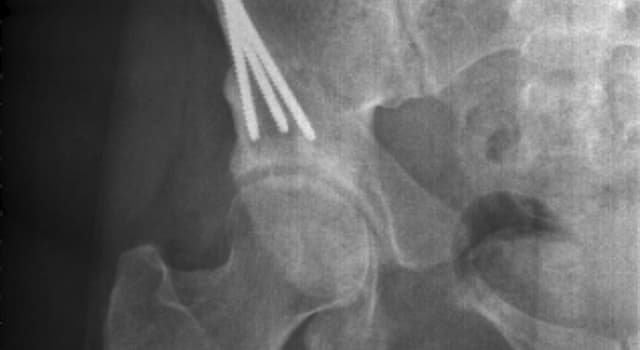 Science Question: Quels sont les os habituellement touchés par la "fracture de la marche" ?