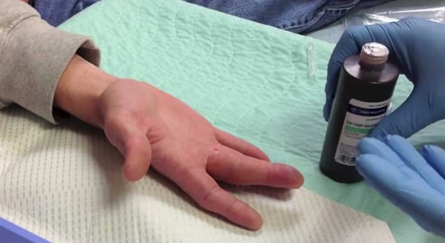 Science Trivia Question: Which term is used to describe an abscessed finger?