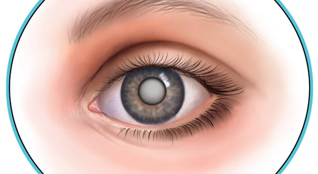 Science Trivia Question: What is a clouding of the lens in the eye which leads to a decrease in vision called?