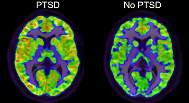 科學 小問題：哪種症狀與創傷後應激障礙（PTSD）相關？