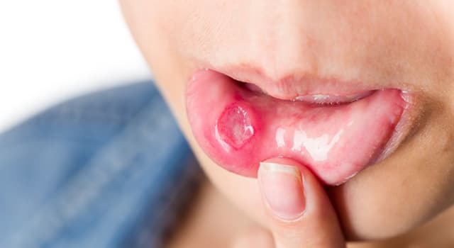Сiencia Pregunta Trivia: ¿Qué tipo de trastorno inflamatorio causa dolorosas llagas en la boca?