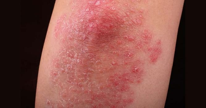 Vetenskap Triviafråga: Vilken del av kroppen påverkas av psoriasis?