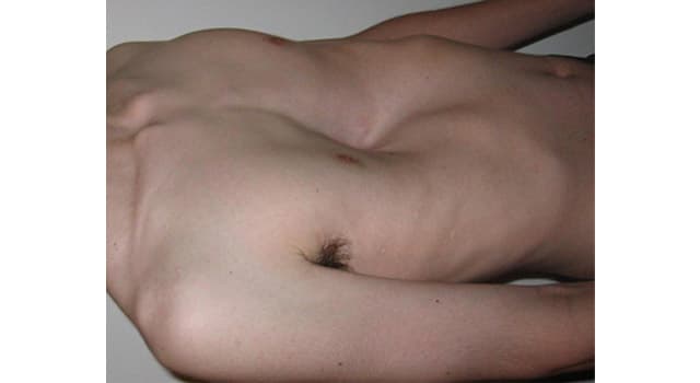 Сiencia Pregunta Trivia: ¿Cómo se llama la deformidad congénita mostrada en la imagen?