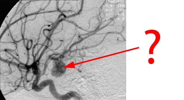 Сiencia Pregunta Trivia: ¿Cómo se llama a la protuberancia en forma de globo surgida por pared débil de una arteria cerebral?