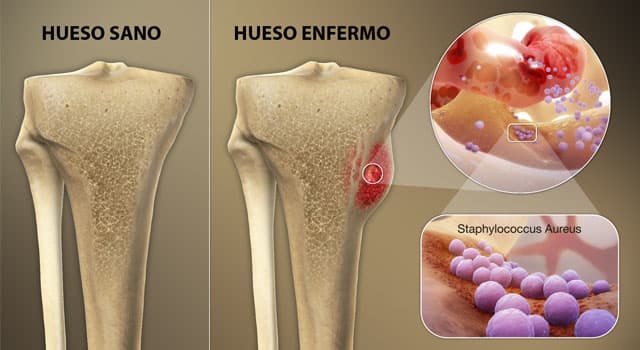 Сiencia Pregunta Trivia: ¿Qué infección ósea suele causar el estafilococo áureo?