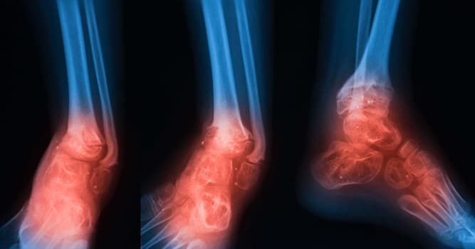 Science Trivia Question: What is an infection of bone called?
