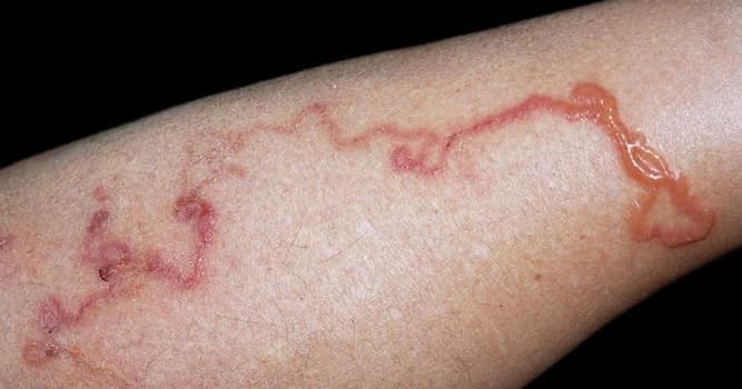 Сiencia Pregunta Trivia: ¿Qué enfermedad causa el Ancylostoma Braziliense?