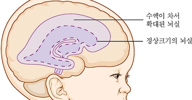 과학 상식 퀴즈: 뇌 안에 뇌척수액(cerebrospinal fluid)이 축적되는 현상은 무엇인가?