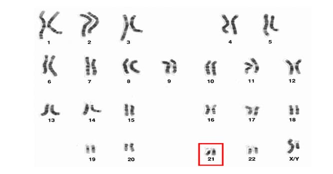 nauka Pytanie-Ciekawostka: Jakie zaburzenie genetyczne jest spowodowane trisomią 21. pary chromosomów?