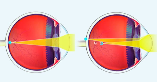 Наука Вопрос: Как называется нарушение зрения, вызванное измененной формой роговицы?