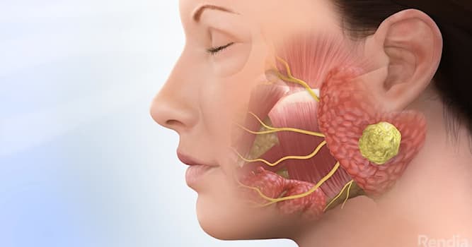 Science Trivia Question: Which is the most common tumor of the parotid gland?