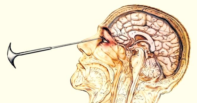 Science Trivia Question: Who developed the leucotomy (lobotomy) procedure?
