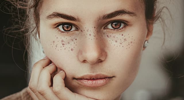Scienza Domande: Cos'è l'acne?