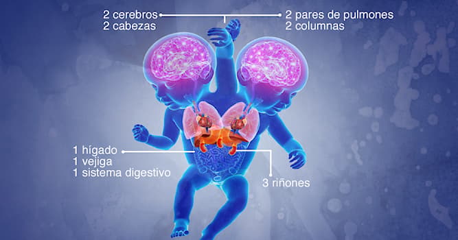 Сiencia Pregunta Trivia: ¿Qué son las personas siamesas?