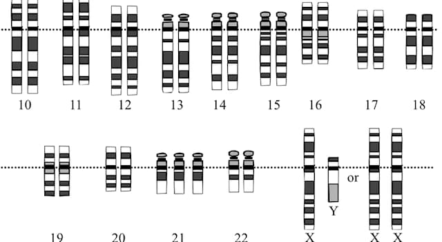 nauka Pytanie-Ciekawostka: Który z chromosomów jest dodatkowy u ludzi dotkniętych syndromem Downa?