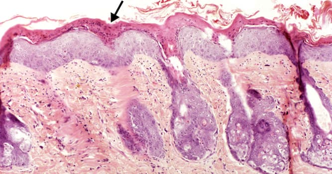 Ciências Pergunta Trivial: O que é denominado espessamento do estrato córneo (camada da epiderme) da pele?