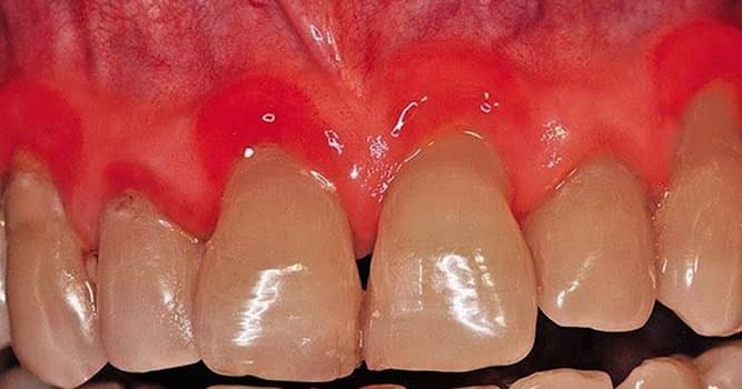 Сiencia Pregunta Trivia: ¿Qué enfermedad se le conoce como la boca de trinchera?
