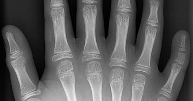 Wetenschap Trivia Vraag: Bij welk orgaan leidt een teveel aan exemplaren tot polydactylie?