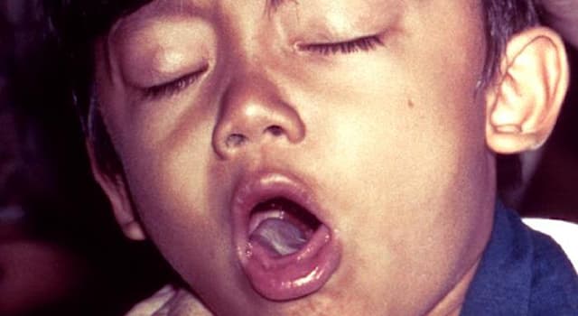 Сiencia Pregunta Trivia: ¿Cuál es el nombre correcto de una enfermedad infantil?