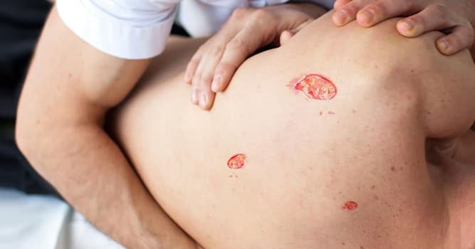 Wetenschap Trivia Vraag: Wat zijn doorligwonden?