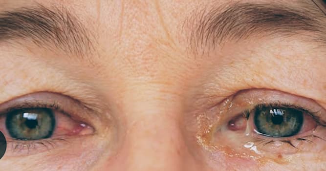 Wetenschap Trivia Vraag: Wat is een symptoom van conjunctivitis?