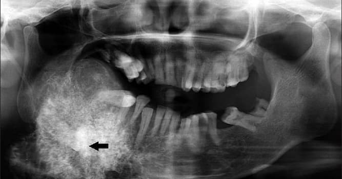 Science Trivia Question: What is another name for Pindborg tumor?