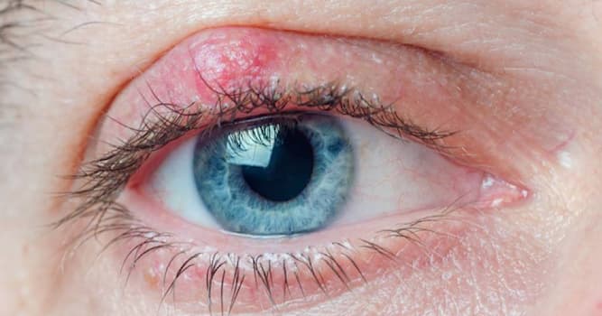 Wetenschap Trivia Vraag: Een chalazion is een infectie van welk orgaan?