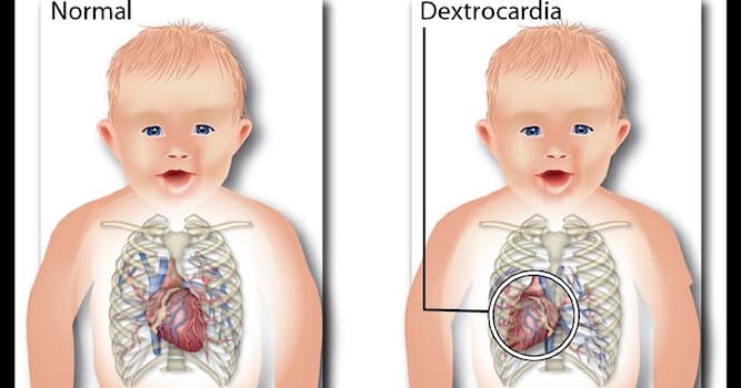 nauka Pytanie-Ciekawostka: Co oznacza dekstrokardia?