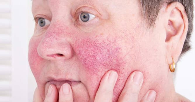 Wetenschap Trivia Vraag: Wat is rosacea?