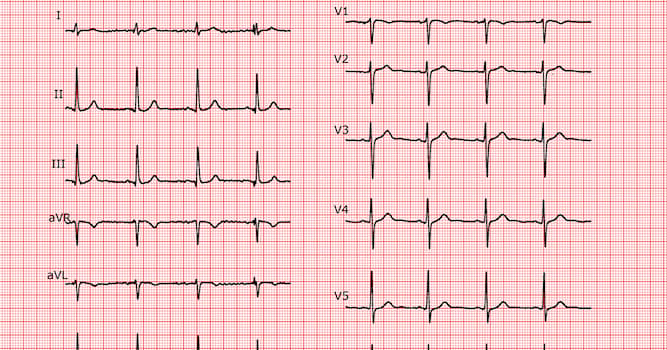 Science Question: Qu'est-ce qu'un électrocardiogramme ?