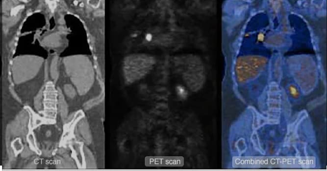 nauka Pytanie-Ciekawostka: Do czego służy badanie PET (pozytonowa tomografia emisyjna)?