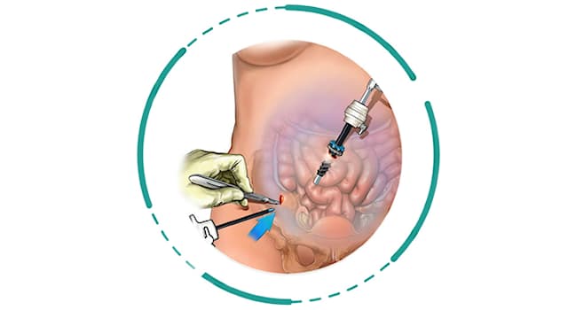 Bilim Trivia Sorusu: Appendiksin alınması ameliyatına ne ad verilir?