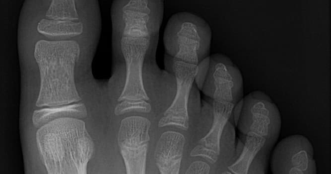 Naturaleza Pregunta Trivia: ¿Qué es la polidactilia?